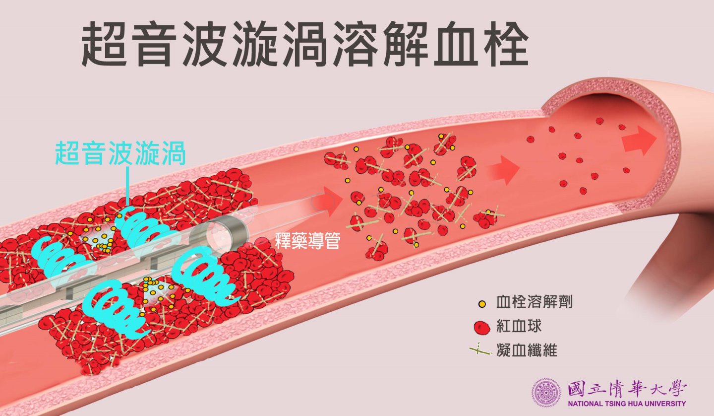 c用龍捲風溶解血栓 清華研發超音波漩渦技術