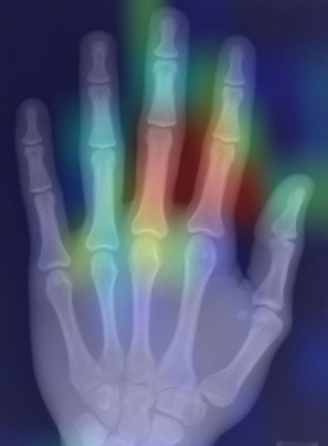 人工智慧聚焦X光片食指、中指的第三指節(紅色處)來判斷人種