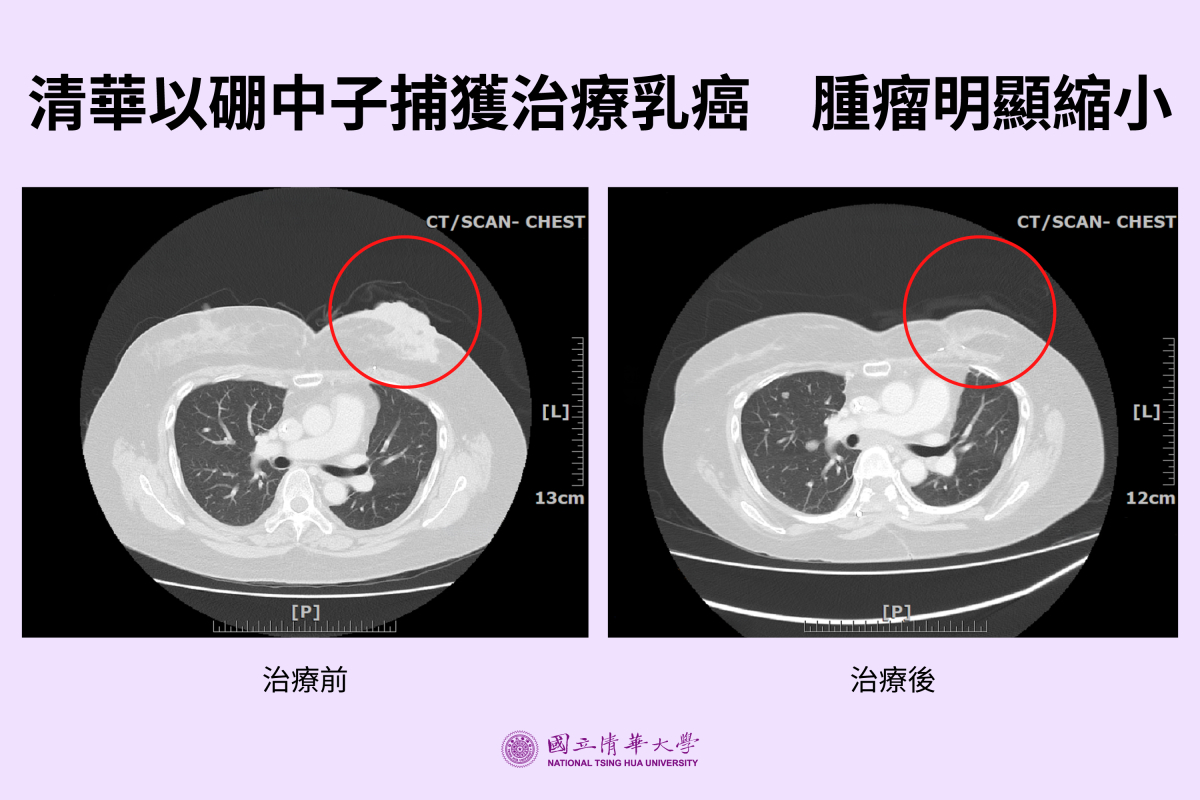 電腦斷層影像顯示，乳癌患者接受BNCT治療後，照射區內的腫瘤明顯縮小。紅圈為腫瘤位置。（陳一瑋醫師提供）